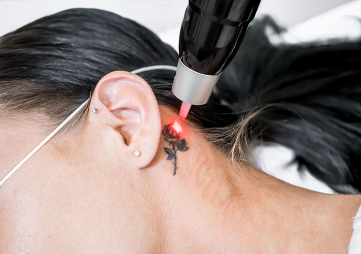Close up of laser tattoo removal behind a woman's ear.