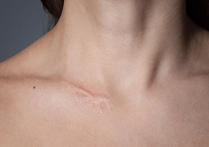 Close up of a lower neck scar