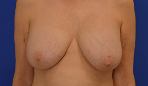 Actual patient before a breast implant replacement