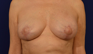 Actual patient after a breast implant replacement